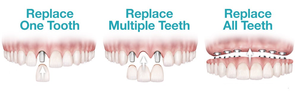 Dental implant options