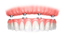 Implant supported overdenture: all on 4 denture